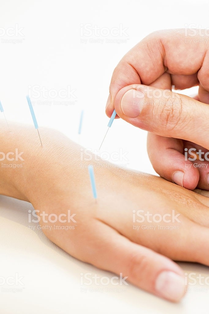 Image result for acupuncture hand needles"